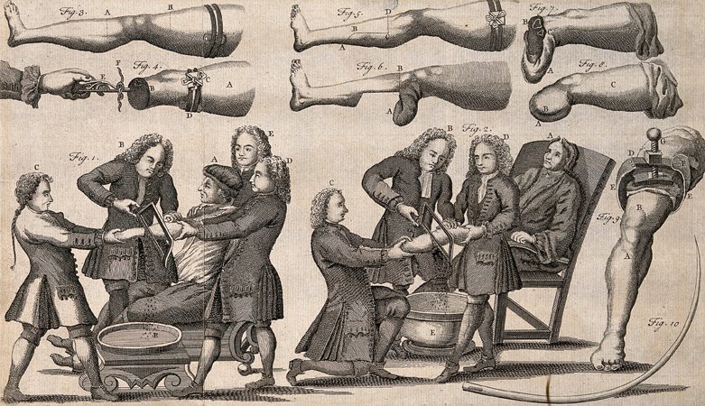 18th century surgeons amputating an arm and a leg while patients are seated in armchairs